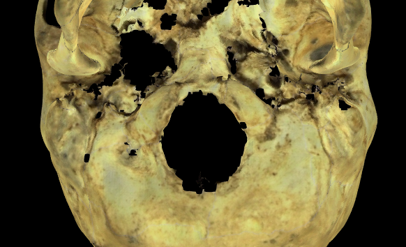Imagen ampliada mostrando la región del foramen magnum en el modelo 3D de un cráneo en Norma Basalis. Se puede observar un escaneo inadecuado de la región con presencia de ruido