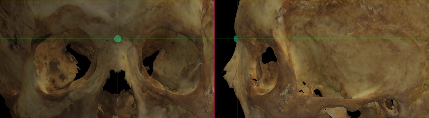 Imagen ampliada mostrando el nasion en un modelo 3D del cráneo en Norma Frontalis y Norma Lateralis