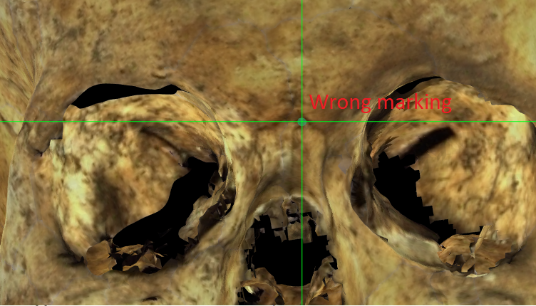 Imagen ampliada mostrando una localización errónea de nasion en un modelo 3D del cráneo
