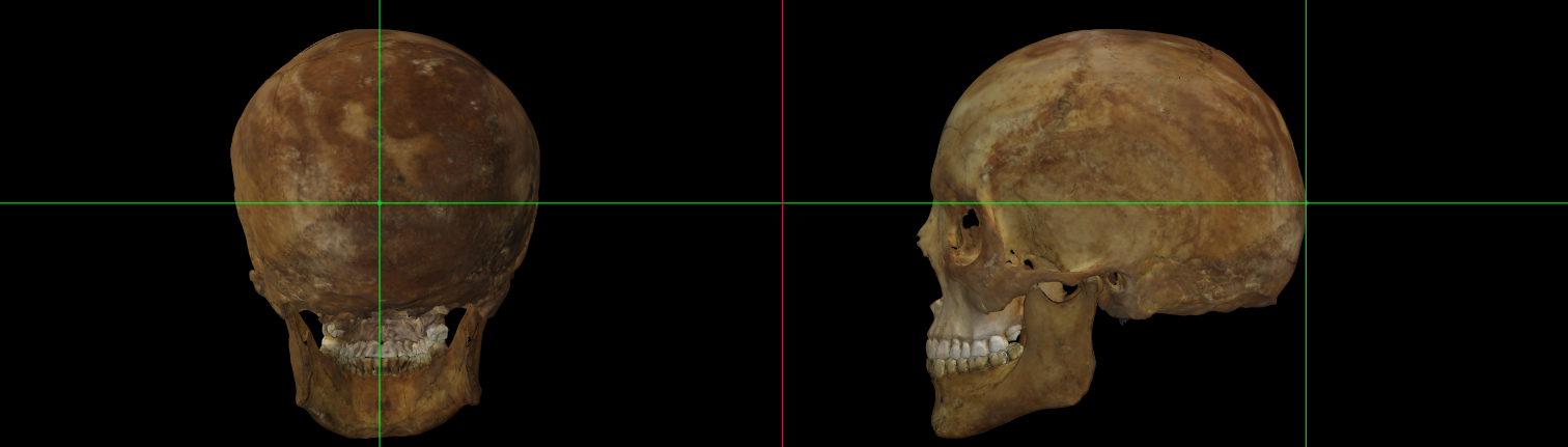 Opisthocranion en un modelo 3D de un cráneo en Norma Occipitalis y Norma Lateralis