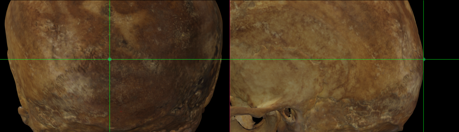 Imagen ampliada mostrando el opisthocranion en un modelo 3D de un cráneo en Norma Occipitalis y Norma Lateralis