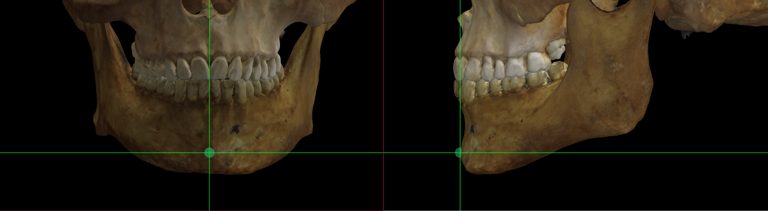 Imagen ampliada mostrando pogonion en un modelo 3D de un cráneo en Norma Frontalis y Norma Lateralis