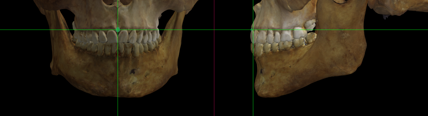 Imagen ampliada mostrando el prosthion en un modelo 3D del cráneo en Norma Frontalis y Norma Lateralis