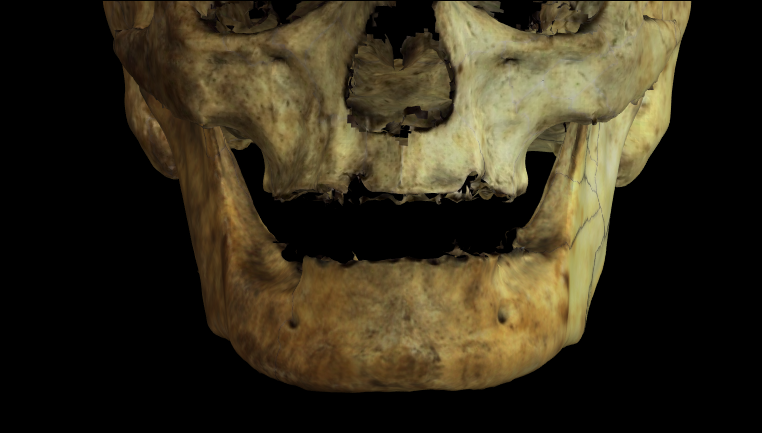 Imagen ampliada mostrando el maxilar y la mandíbula de un individuo edéntulo en Norma Frontalis