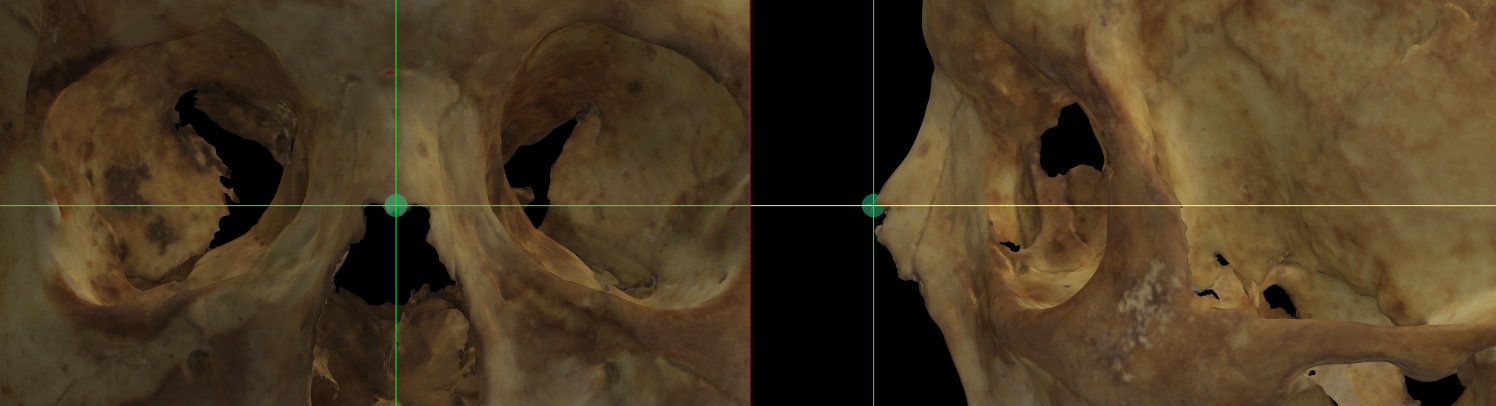 Imagen ampliada mostrando el rhinion en un modelo 3D del cráneo en Norma Frontalis y Norma Lateralis