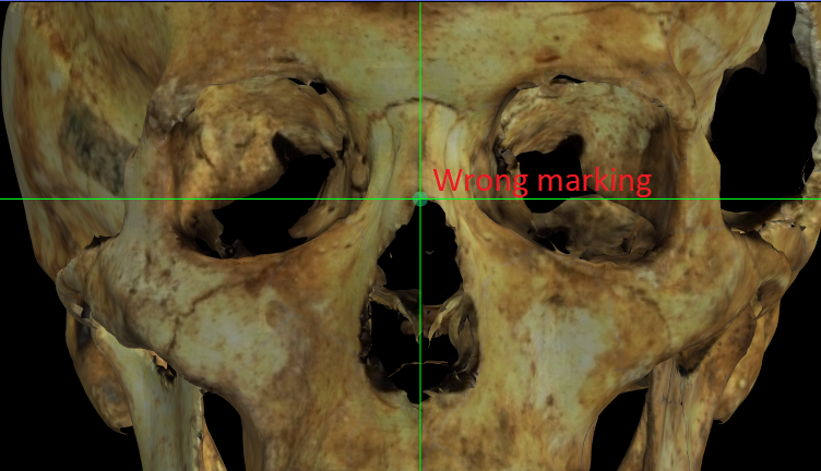 Magnified image showing a wrong located Rhinion on a skull 3D model with the nasal bone broken in Norma Frontalis