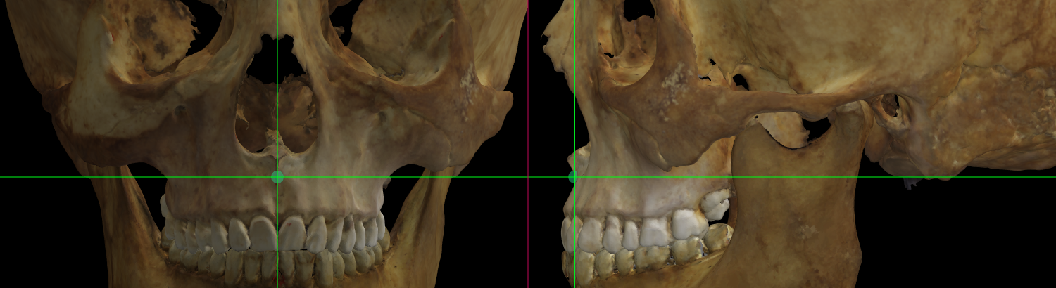 Magnified image showing Subspinale on a skull 3D model in Norma Frontalis and Norma Lateralis