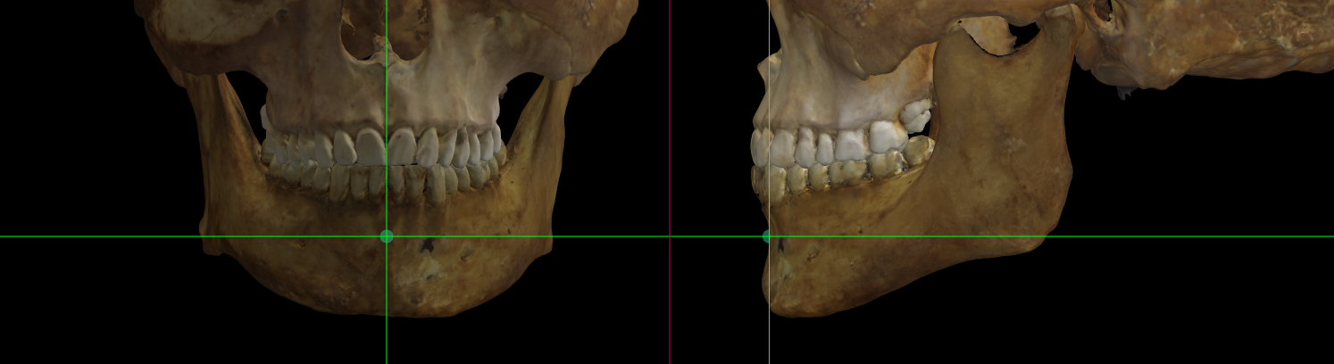 Imagen ampliada mostrando el supramentale en un modelo 3D del cráneo en Norma Frontalis y Norma Lateralis