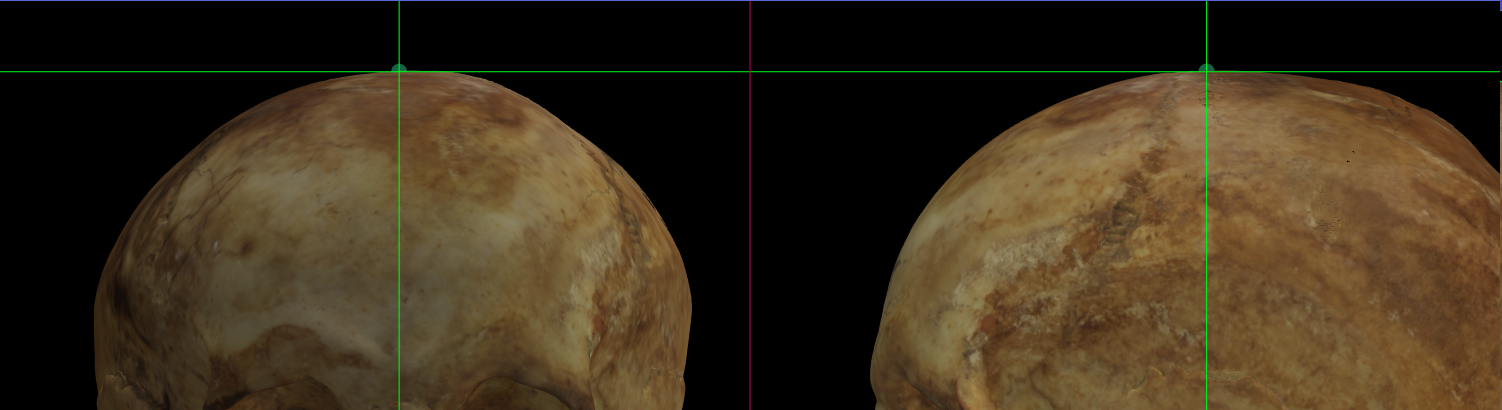 Imagen ampliada mostrando vertex en un modelo 3D del cráneo en Norma Frontalis y Norma Lateralis