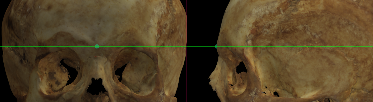 Imagen ampliada mostrando Glabella en un modelo 3D del cráneo en Norma Frontalis y Norma Lateralis
