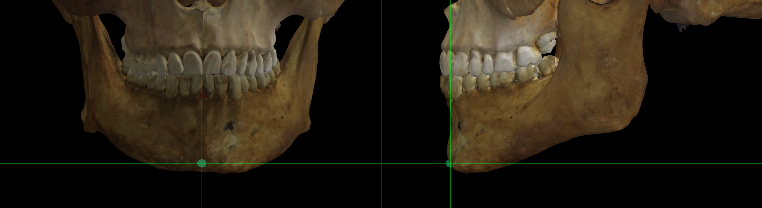 Magnified image showing Gnathion on a skull 3D model in Norma Frontalis and Norma Lateralis