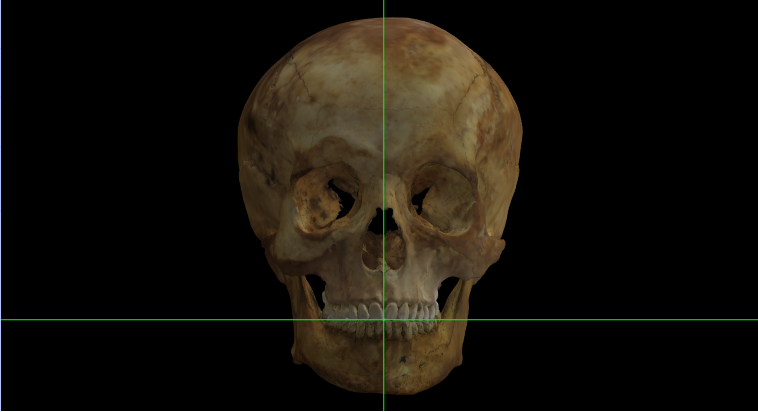 Incision en el modelo 3D de un cráneo en Norma Frontalis
