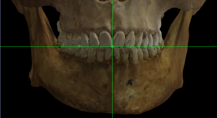 Imagen ampliada de incision en el modelo 3D de un cráneo en Norma Frontalis