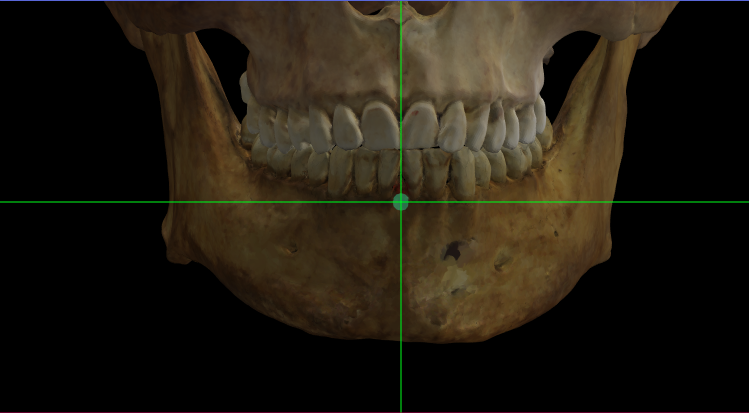 Imagen ampliada mostrando infradentale en el modelo 3D de un cráneo en Norma Frontalis