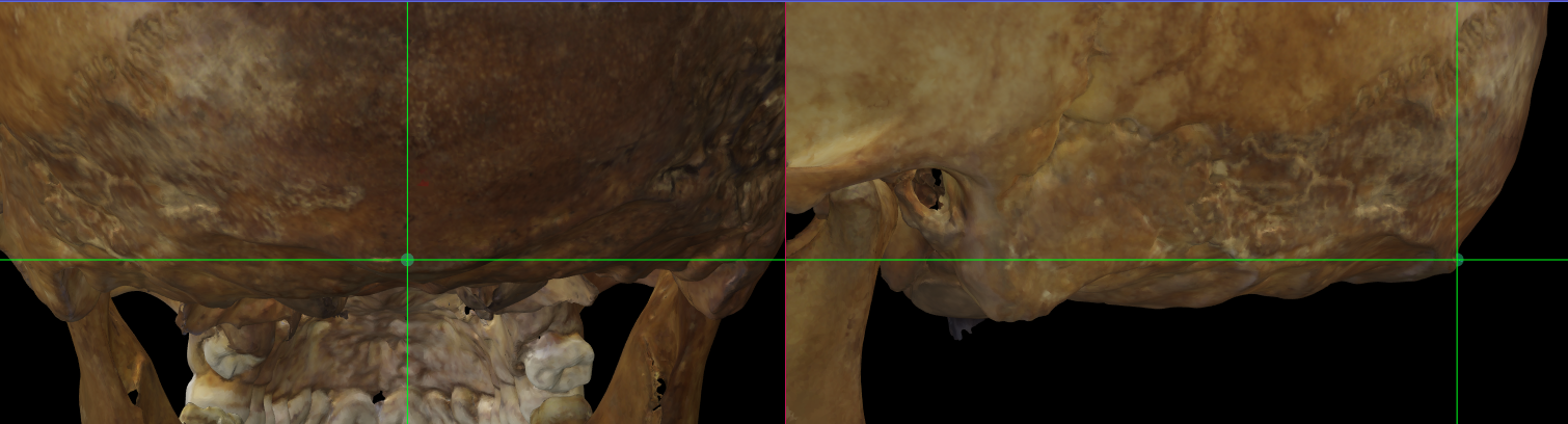 Imagen ampliada mostrando el inion en el modelo 3D de un cráneo en Norma Occipitalis y Norma Lateralis