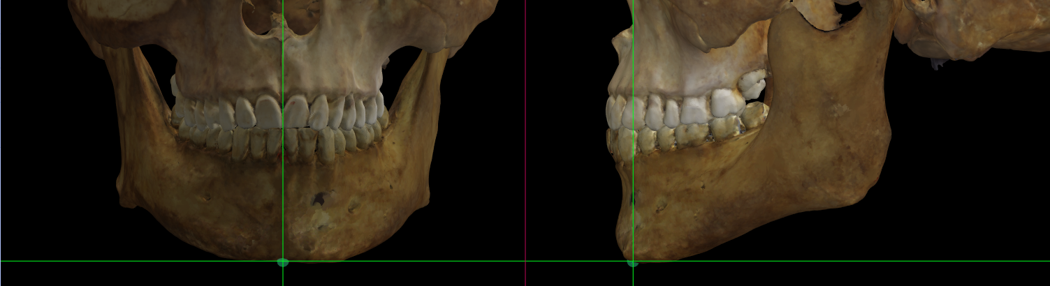 Magnified image showing Menton on a skull 3D model in Norma Frontalis and Norma Lateralis