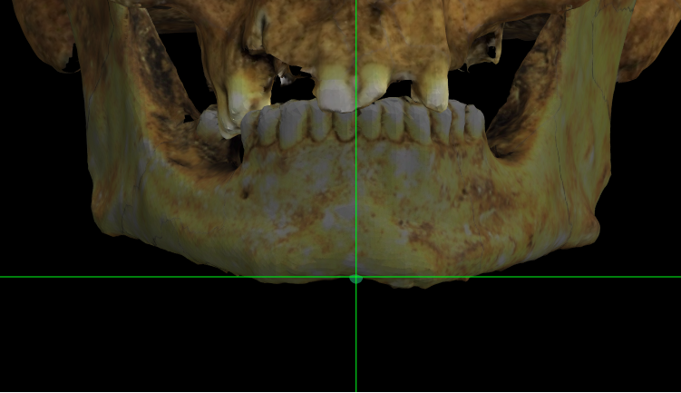 Imagen ampliada mostrando menton en un modelo 3D de un cráneo con el mentón hendido en Norma Frontalis