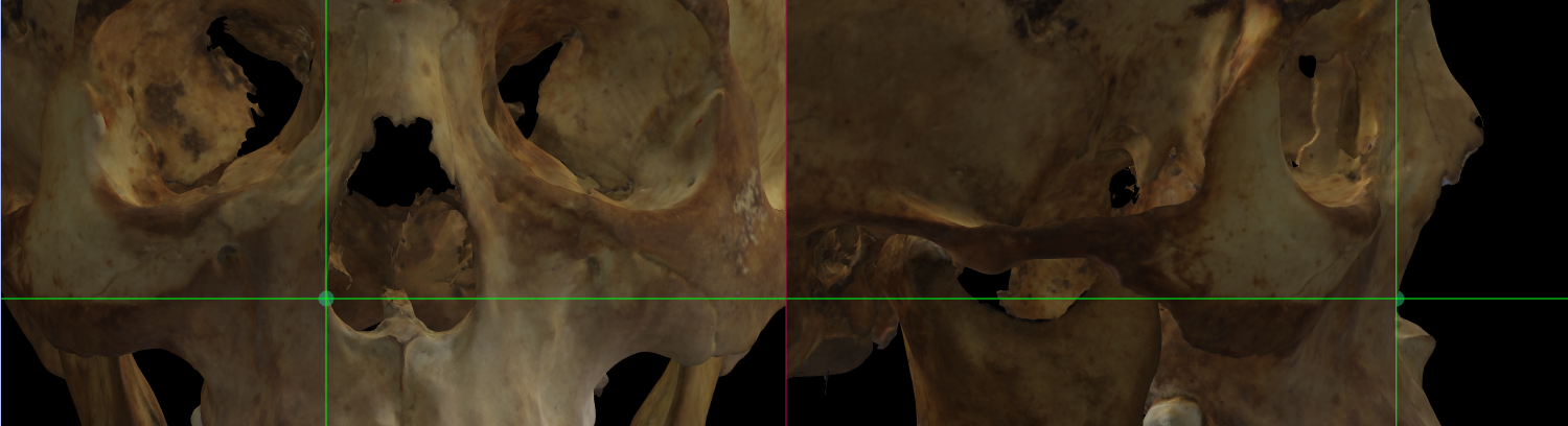 Magnified image showing Alare (right) on a skull 3D model in Norma Frontalis and Norma Lateralis