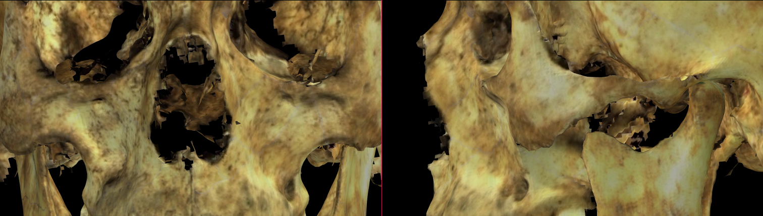 Imagen ampliada mostrando un escaneo impreciso en la región de la abertura piriforme en Norma Frontalis (izquierda) y Norma Lateralis (derecha)