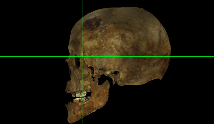 Frontomalare temporale (izquierda) en un modelo 3D del cráneo en Norma Lateralis