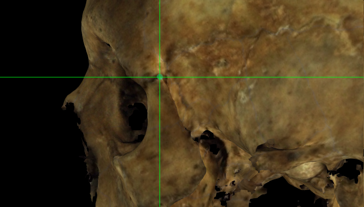 Imagen ampliada mostrando frontomalare temporale (izquierdo) en un modelo 3D del cráneo en Norma Lateralis