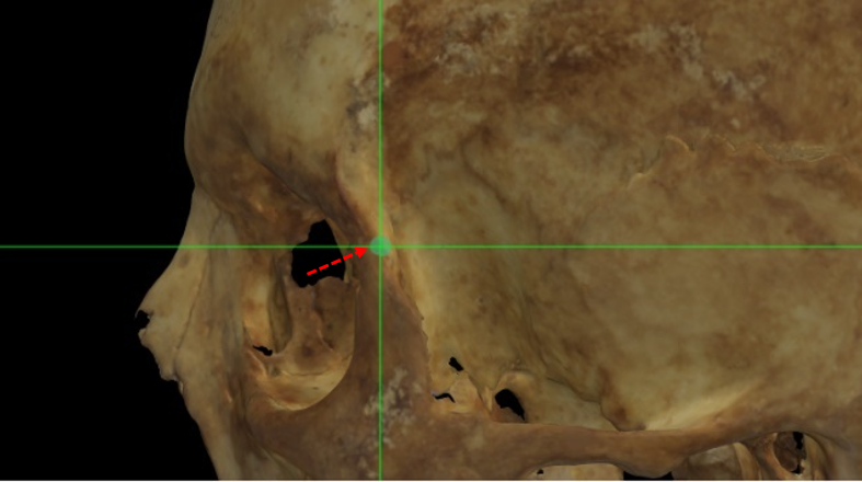 Imagen ampliada mostrando el frontomalare temporale (izquierdo) estimado en un modelo 3D del cráneo con una baja definición de la sutura en Norma Lateralis