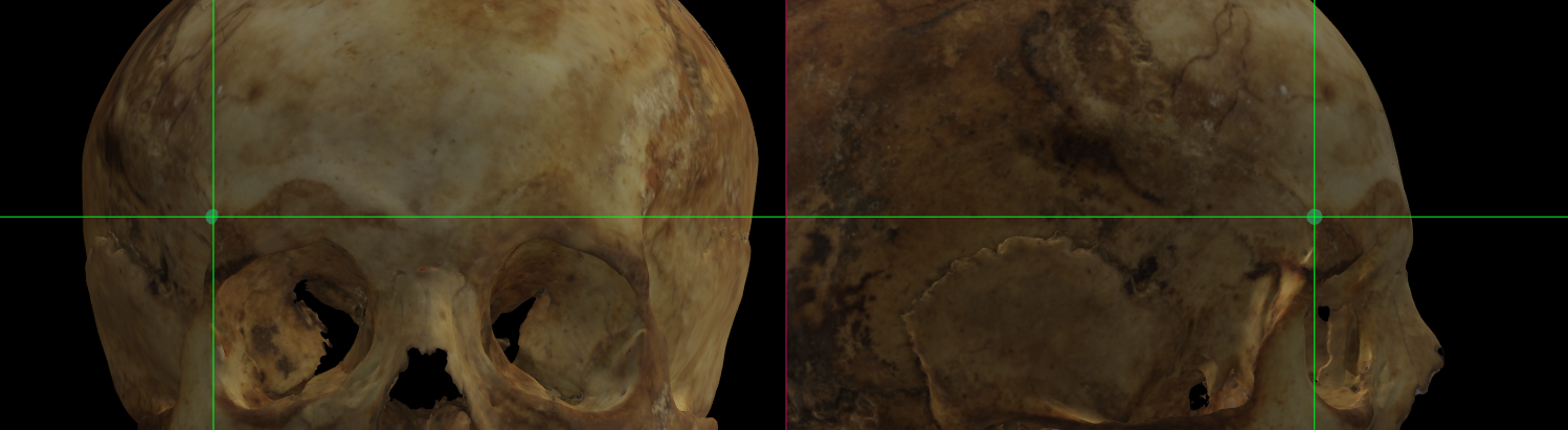 Imagen ampliada mostrando frontotemporale (derecho) en un modelo 3D del cráneo en Norma Frontalis y Norma Lateralis