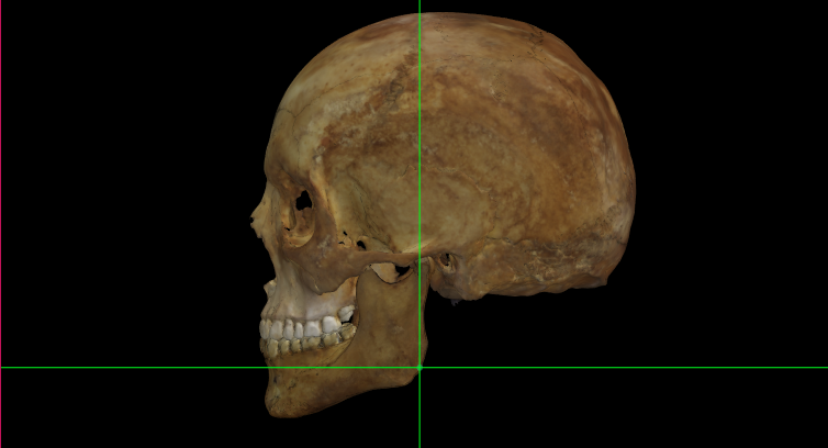 Gonion (izquierdo) en un modelo 3D del cráneo en Norma Lateralis