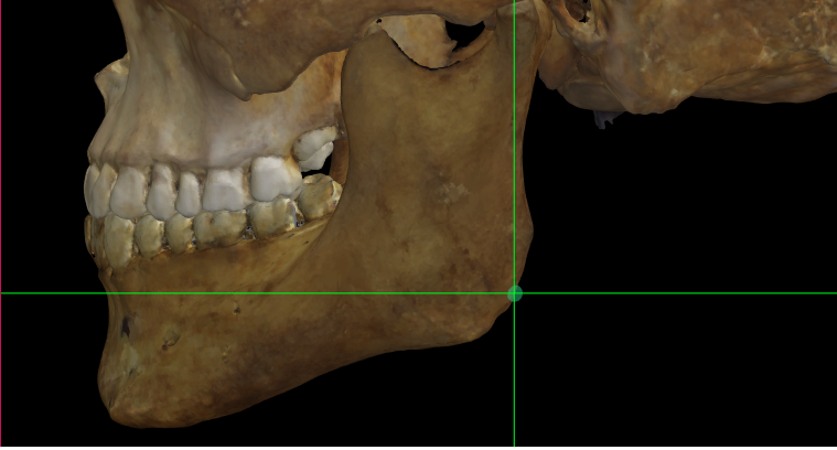 Imagen ampliada mostrando gonion (izquierdo) en un modelo 3D del cráneo en Norma Lateralis