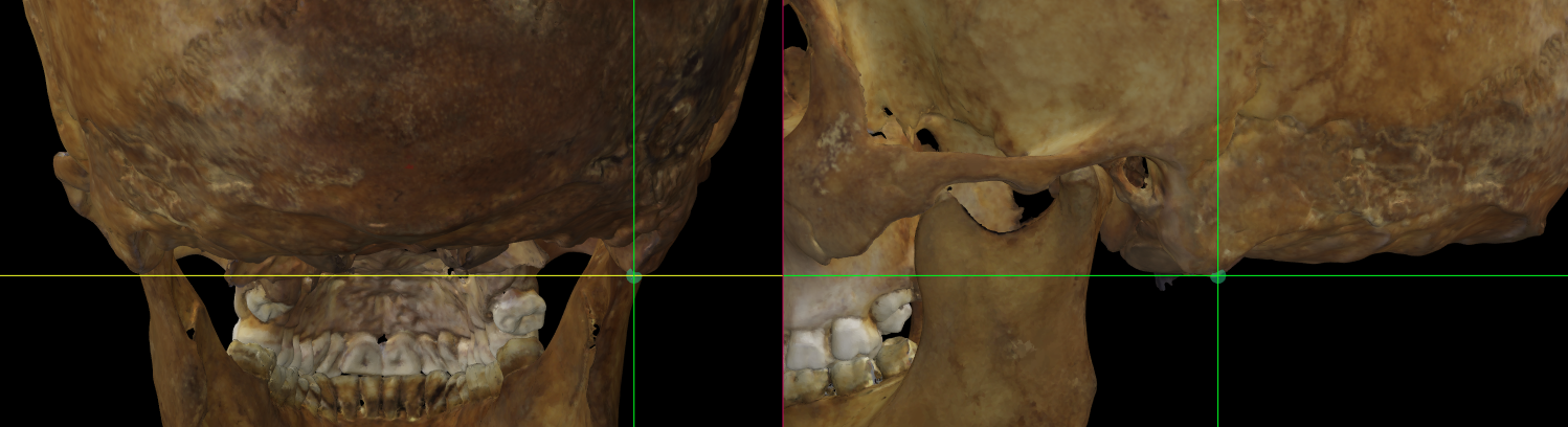 Imagen ampliada mostrando el mastoidale (izquierdo) en un modelo 3D del cráneo en Norma Occipitalis y Norma Lateralis