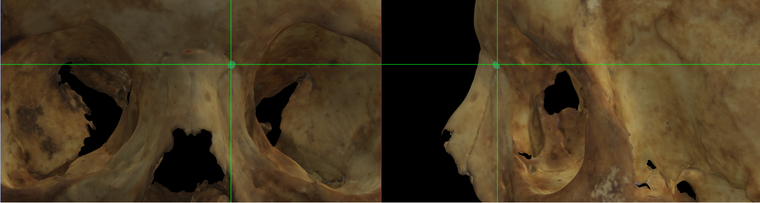 Magnified image showing Maxillofrontale (left) on a skull 3D model in Norma Frontalis and Norma Lateralis
