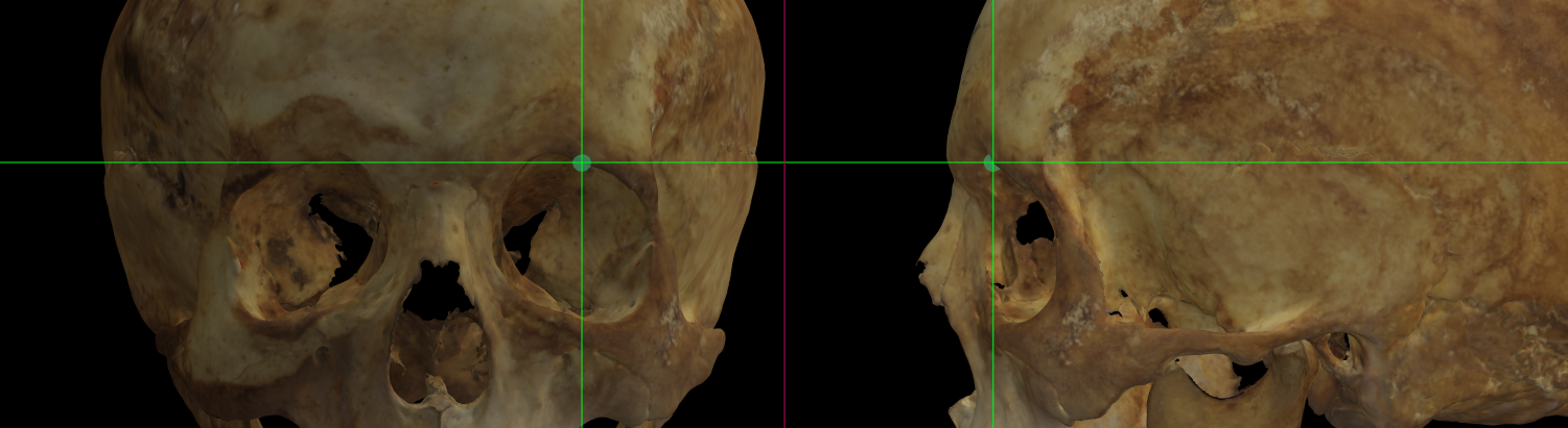 Imagen ampliada mostrando el mid-supraorbitale (izquierdo) en un modelo 3D de un cráneo en Norma Frontalis y Norma Lateralis