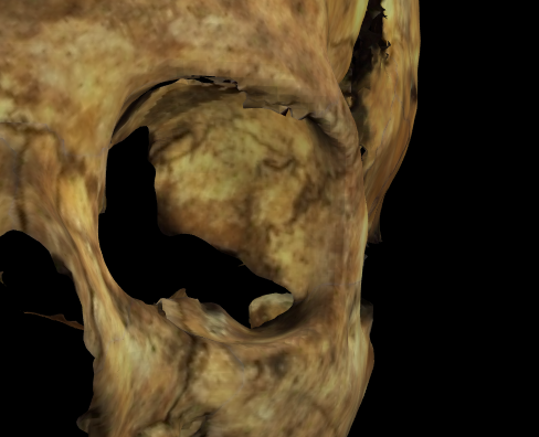 Imagen ampliada mostrando un mal escaneo (con ruido) de la órbita izquierda en un modelo 3D de un cráneo