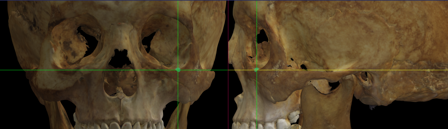 Imagen ampliada mostrando el orbitale izquierdo en un modelo 3D del cráneo en Norma Frontalis y Norma Lateralis