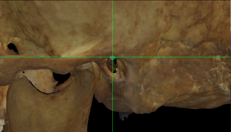 Magnified image showing Porion (left) on a skull 3D model in Norma Lateralis