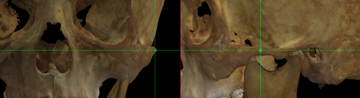Imagen ampliada mostrando el zygion (izquierdo) en un modelo 3D del cráneo en Norma Frontalis y Norma Lateralis