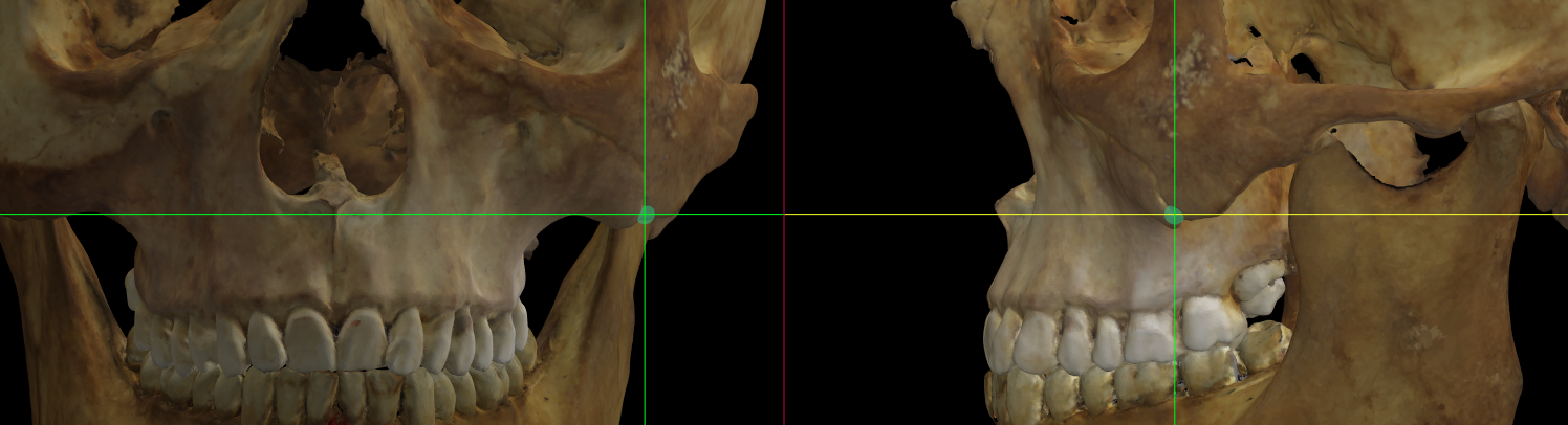 Imagen ampliada mostrando el zygomaxillare (izquierdo) en un modelo 3D del cráneo en Norma Frontalis y Norma Lateralis