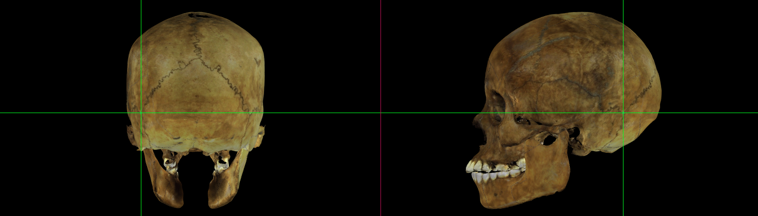 Asterion (izquierdo) en un modelo 3D del cráneo en Norma Occipitalis y Norma Lateralis