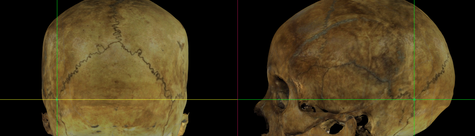 Imagen ampliada mostrando el asterion (izquierdo) en un modelo 3D del cráneo en Norma Occipitalis y Norma Lateralis