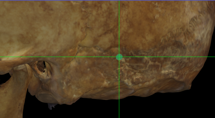 Imagen ampliada mostrando asterion (izquierdo) en un modelo 3D del cráneo con baja resolución de las suturas en Norma Lateralis