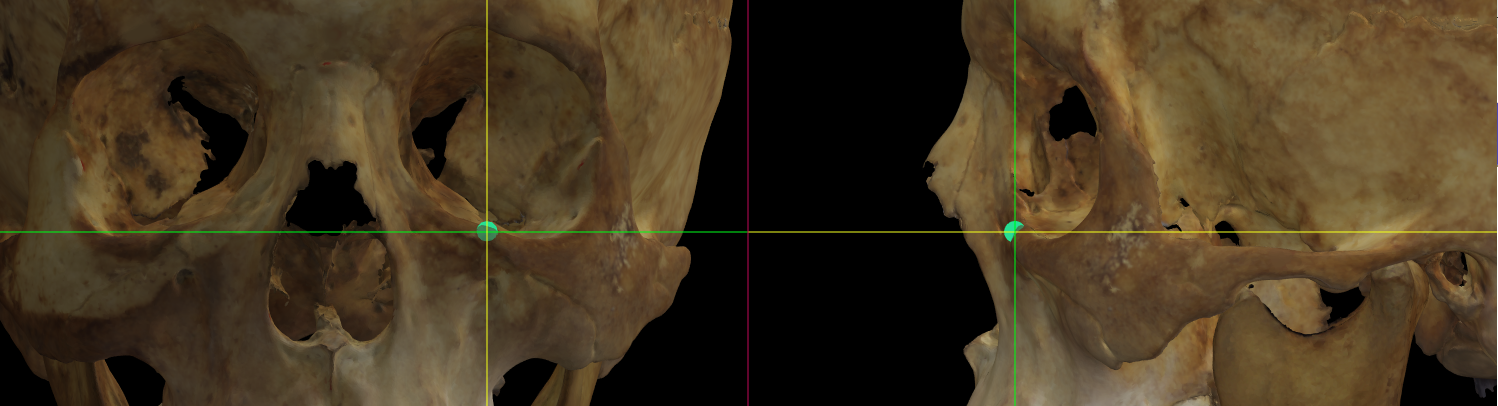 Imagen ampliada mostrando el zygoorbitale (izquierdo) en un modelo 3D del cráneo en Norma Frontalis y Norma Lateralis