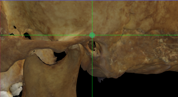 Imagen ampliada mostrando auriculare (izquierdo) en un modelo 3D del cráneo en Norma Lateralis