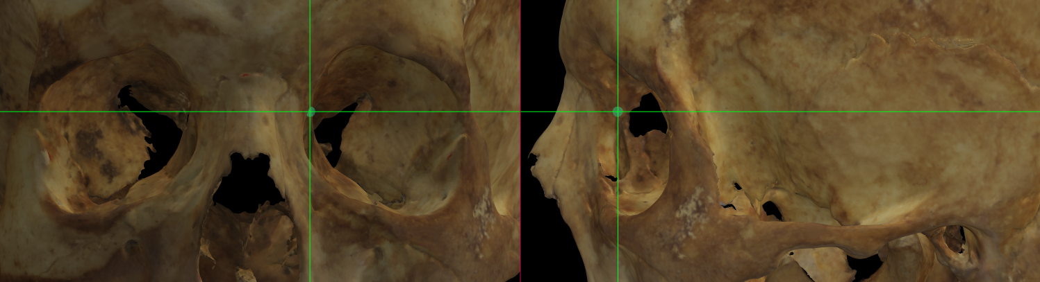 Imagen ampliada de coronale (izquierdo) en un modelo 3D del cráneo en Norma Verticalis