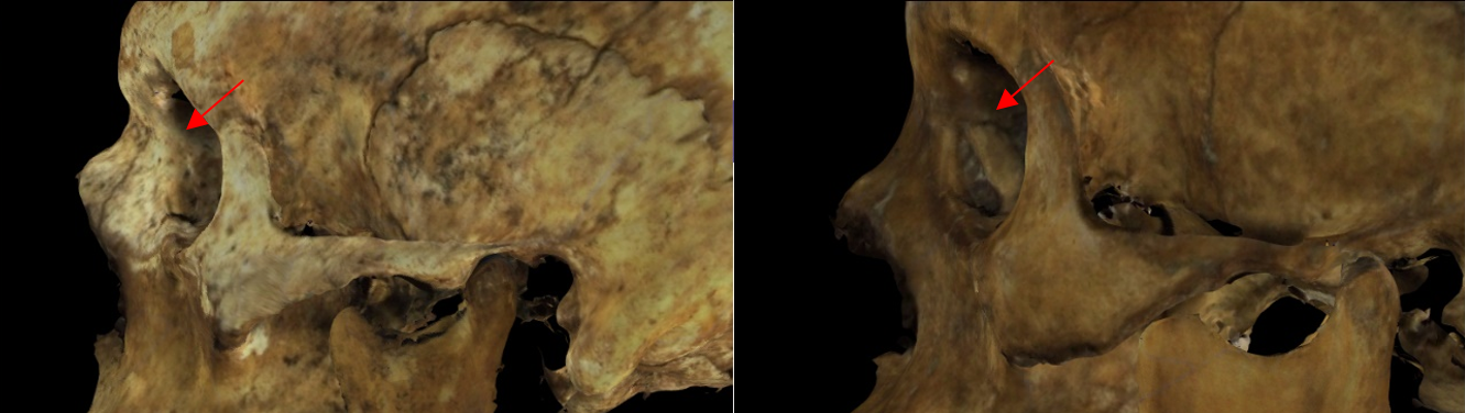 Imagen ampliada mostrando la órbita izquierda en un modelo 3D de un cráneo en Norma Lateralis. En el cráneo de la izquierda, la sutura lacrimomaxilar es prácticamente imperceptible mientras que en el cráneo de la derecha está bien definida