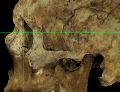 Imagen ampliada mostrando el dacryon (izquierdo) estimado en el ápice de la fosa lacrimal en un modelo 3D de un cráneo