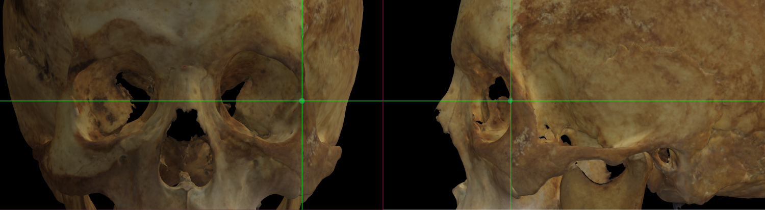 Imagen ampliada mostrando ectoconchion (izquierdo) en un modelo 3D de un cráneo en Norma Frontalis y Norma Lateralis