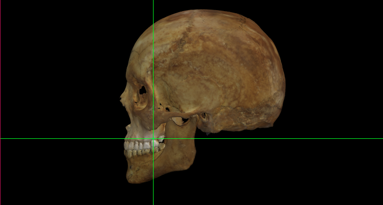 Ectomolare (izquierdo) en un modelo 3D de un cráneo en Norma Lateralis