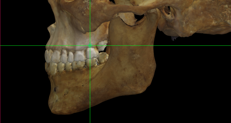  Imagen ampliada mostrando ectomolare (izquierdo) en un modelo 3D de un cráneo en Norma Lateralis