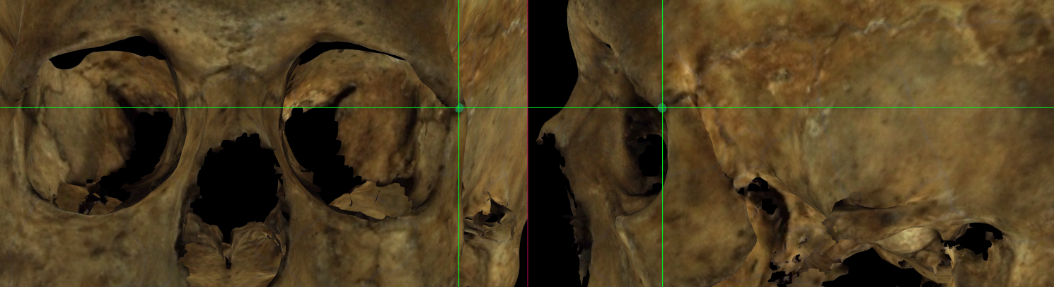 Imagen ampliada mostrando frontomalare anterior (izquierdo) en un modelo 3D del cráneo en Norma Frontalis y Norma Lateralis