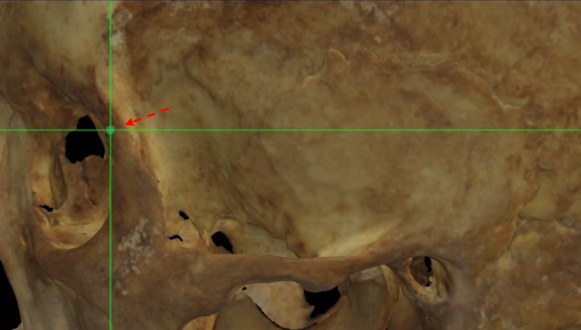 Imagen ampliada mostrando el frontomalare anterior (izquierdo) estimado en un modelo 3D de un cráneo en Norma Lateralis con una escasa definición de la sutura frontomalar